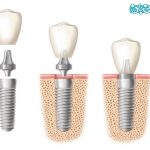 انواع ایمپلنت دندان کره ای بهتر است یا آلمانی؟